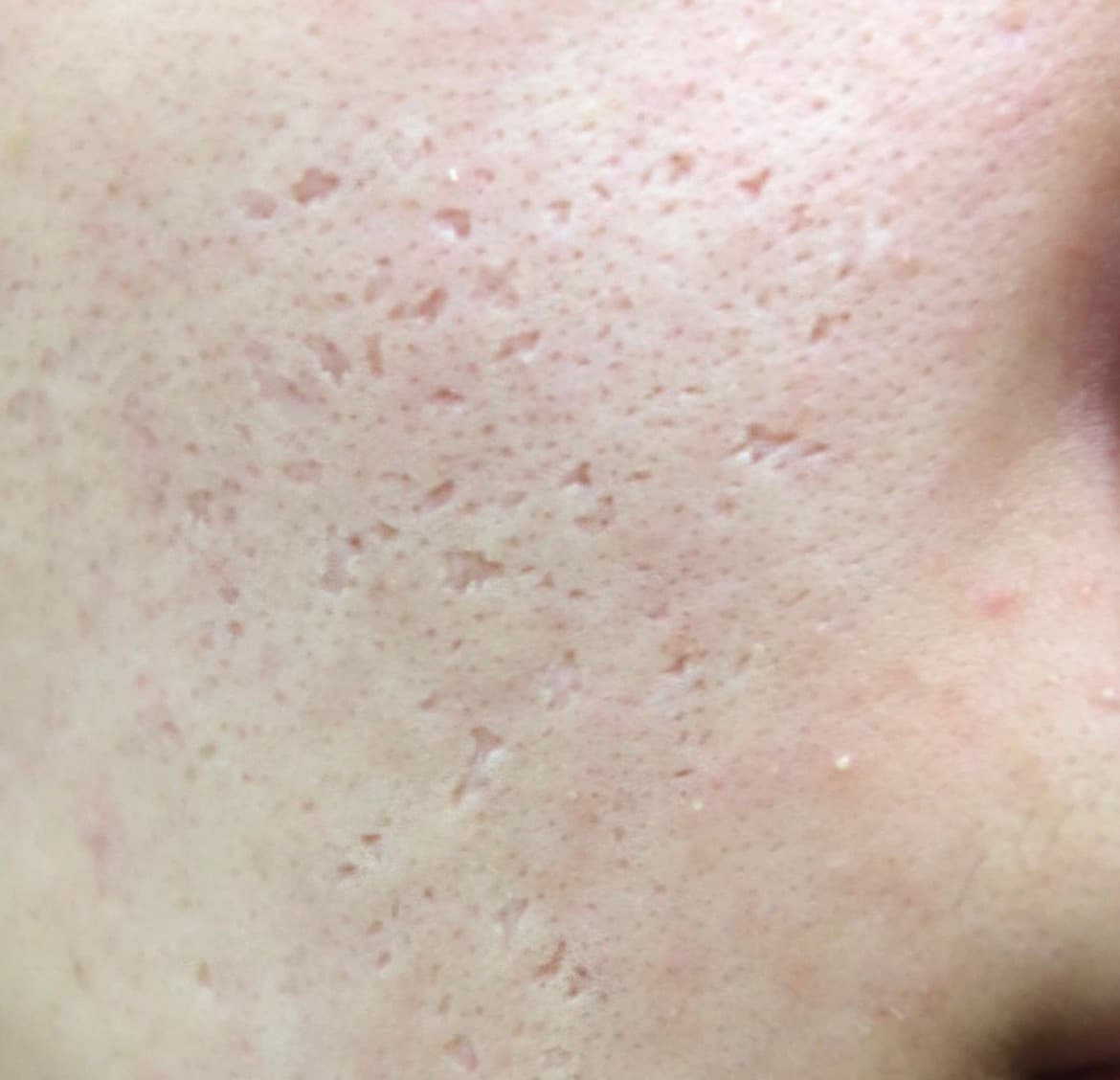 The story behind Acne Reset